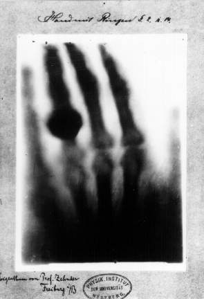 Prima radiografia eseguita da Röntgen