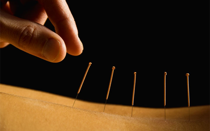 Agopunture - Acupuncture